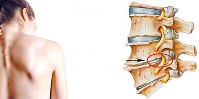 Mechanismus vývoje cervikální osteochondózy
