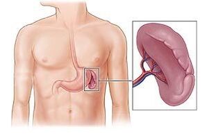 patologie sleziny jako příčina bolesti pod levou lopatkou