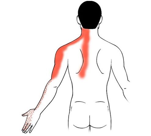 cervikální osteochondróza jako příčina bolesti v kloubech prstů